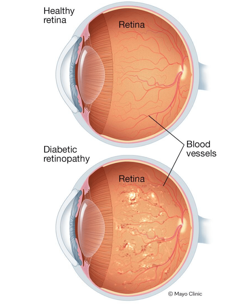 retinopatia diabetică